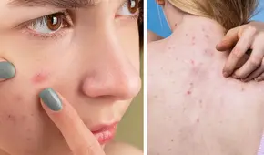 ¿Por qué no se deben reventar las espinillas y granos de la cara y espalda?