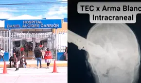 Junín: joven termina con cuchillo incrustado en el cráneo luego de pelea en fiesta