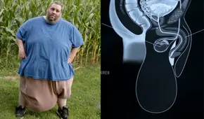 El curioso caso del hombre que vivió con un testículo de 30 kilos antes de ser operado