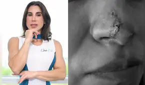 ‘Dra. Fit’ fue denunciada por aplicar metacrilato a sus pacientes, una sustancia que las dejó deformadas  