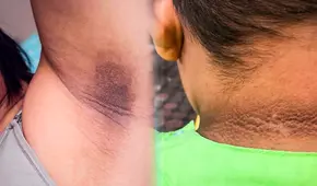 ¿Por qué me salen manchas oscuras en el cuello, axilas o entrepierna, y cómo eliminarlas?