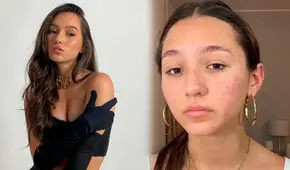 Alexia Barnechea se quiebra al revelar el severo acné que padece: “Voy a cuidar de mí”