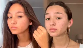 Ale Barnechea agradece apoyo de fans tras revelar padecer acné: "Intento mostrarme sin filtros"