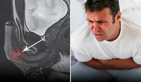 Hombre se fracturó el pene mientras practicaba la pose sexual ‘más peligrosa del mundo’