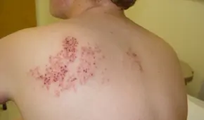 ¿Cómo es la 'segunda varicela', que aparece en 1 de cada 3 adultos?