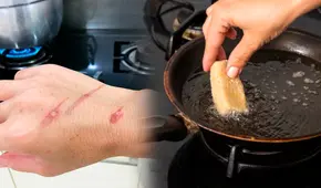 ¿Las quemaduras con aceite dejan cicatrices? Conoce cómo tratar estas heridas