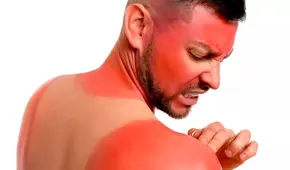 Los mejores 5 remedios caseros para tratar la piel después de una insolación