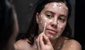 ¿Es cierto que la varicela en adultos es más grave que en los niños? EsSalud responde