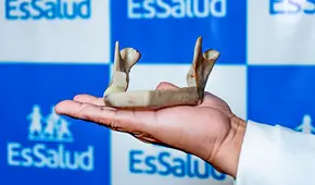 Reconstruyen mandíbula de paciente oncológico con un pedazo de su propio peroné en hospital Almenara