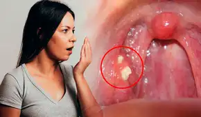 ¿Por qué me salen bolitas amarillas en la garganta y cómo puedo eliminarlas para no tener mal aliento? ¿Por qué me salen bolitas amarillas en la garganta y cómo puedo eliminarlas para no tener mal aliento?