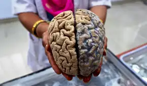 Estudio sugiere que un tratamiento hormonal transmitió el alzheimer a personas sanas y jóvenes