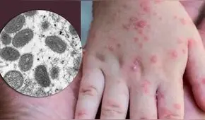 Minsa reporta primer caso de viruela del mono en Piura durante el 2024