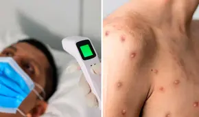 INS reporta 30 casos de viruela del mono a nivel nacional: la mayoría está en Lima