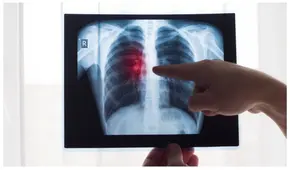 OMS: Fumar provoca hasta veinte tipos de cáncer