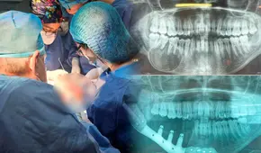 Realizan el primer implante de titanio en mandíbula a paciente con tumor en el Perú: "Si me crecía iba ser peor"