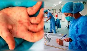 Perú: hay 77 casos de viruela del mono de la cepa clásica