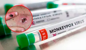 La OMS afirma que la viruela del mono “no es el nuevo COVID” y sabe “cómo luchar” contra el virus
