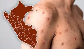 Viruela del mono en Perú: cómo se contagia, cuáles son los síntomas y precauciones para evitar contagio