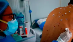 Minsa reporta primer caso de viruela del mono en Huancayo: Hospital Carrión activa triaje especialista