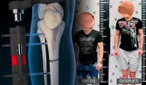 Así es la cirugía extrema para ser más alto: "Te rompen los huesos de las piernas para crecer hasta 15 centímetros"