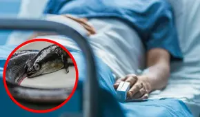 Anguila de 30 cm vivía en estómago de hombre: se introdujo por su recto y le produjo perforaciones en intestino