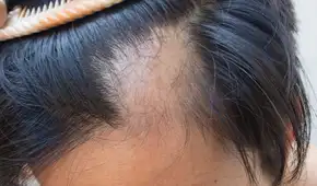 Investigadores de Harvard logran revertir la pérdida de cabello causada por la alopecia