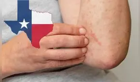 Confirman primera muerte por Sarampión en Texas: más de 120 casos de contagio confirmados