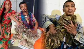 La extraña enfermedad de Abul Bajandar, el 'hombre árbol' que lleva más de 10 años con extremidades de verrugas