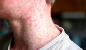 Alarma sanitaria en EE. UU.: se reportan nuevos casos de sarampión en Nueva Jersey y Kentucky