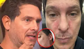 Cristian Rivero revela extraña reacción en su rostro que afecta su salud: “Los nervios existen”