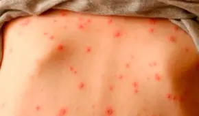 Sarampión en Nueva Jersey: autoridades de salud emiten advertencia por aparición de nuevos casos