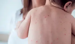 Alerta sanitaria en Colorado: menor de un año contrae sarampión después de un viaje a México