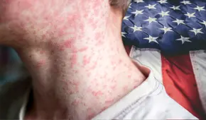 Sarampión en EEUU: conoce los mitos 4 mitos sobre esta enfermedad contagiosa, mientras aumentan los casos