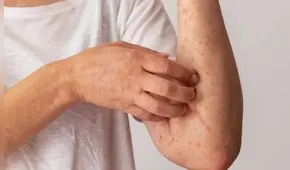 Texas es epicentro del brote de sarampión en EEUU: 597 casos y dos muertes de niños no vacunados