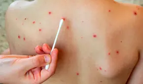 Texas enfrenta el brote de sarampión más grave en 30 años: superan los 600 casos y se ha propagado a 25 estados