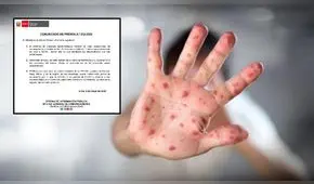 Minsa detecta un caso sospechoso de sarampión en el distrito de Ate