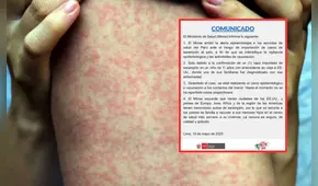 Minsa emite alerta epidemiológica por caso importado de sarampión desde Estados Unidos