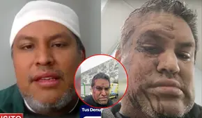 Peruano denuncia agresión xenófoba en Chile y paramédicos se niegan a atenderlo: "Me han roto la cabeza"