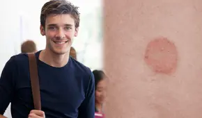 Estudiante consulta en Reddit sobre extraña mancha en su brazo, va al médico y descubre diagnóstico inesperado: es común en EEUU