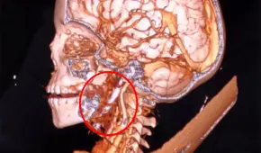 Niño de 7 años sobrevive a un terrible accidente en la India: un clavo de 3 pulgadas se incrustó en su cerebro