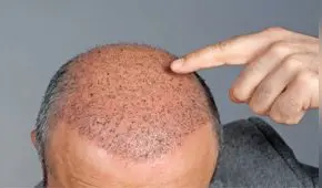 Muere hombre británico tras trasplante capilar en Turquía: clínica es investigada por homicidio imprudente