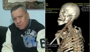 Hombre resbala sobre reja y fierro le atraviesa el cuello en Magdalena, pero logra sobrevivir: “Volví a la vida”