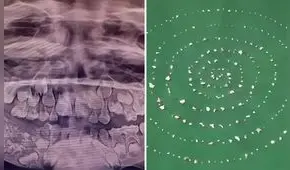 El insólito caso del menor que tenía 526 dientes en la mandíbula y se los extrajeron en una sola cirugía en la India