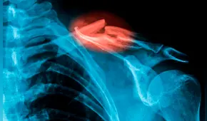Científicos desarrollan una 'pistola de pegamento' 3D para imprimir injertos óseos y reparar fracturas en cirugías