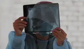 Perú es el país de América Latina con más casos de tuberculosis, según la OMS: Minsa reportó más de 33.000 pacientes en 2024