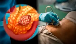 Científicos españoles avanzan en una terapia esperanzadora para eliminar completamente el cáncer de páncreas