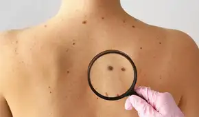 Las recomendaciones del Minsa para la detección temprana de lunares sospechosos y descartar cáncer de piel