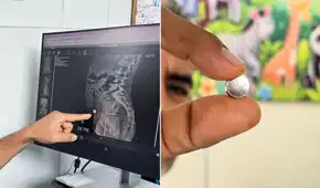 Niña de 6 años sobrevive a perforación intestinal tras ingerir pila de reloj: necesitó cirugía de más de tres horas