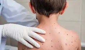 Confirman dos casos de sarampión en Puno y se declara alerta sanitaria en toda la región