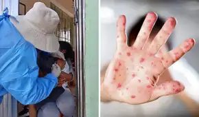 Casos de sarampión se elevan a 15 en Puno: alertan alto riesgo de transmisión a nivel nacional